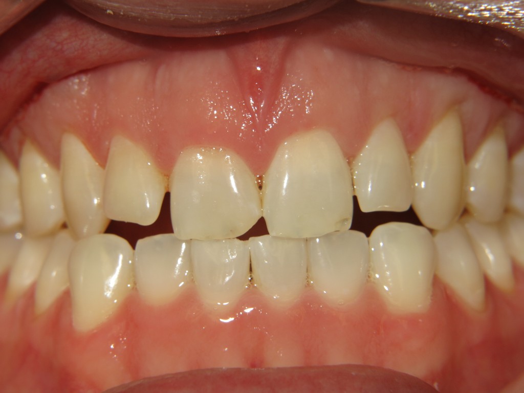Dalton Smile Gallery for Barton Dentistry Before and After Dentist