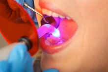 dental bonding curing light