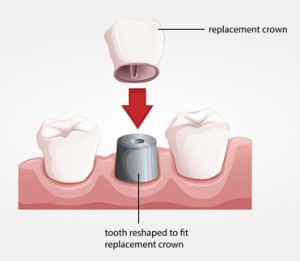 Dental crown procedure