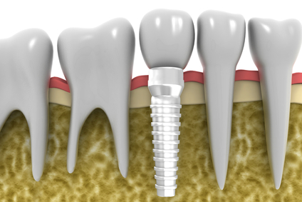 dalton dental implants