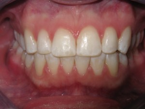 Dalton Invisalign