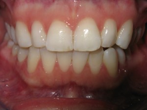 Dalton Invisalign Braces