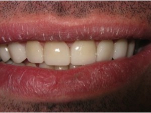 after dental treatment