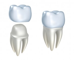 Dalton Porcelain Crowns