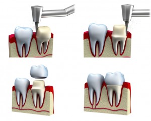Dalton dental crowns