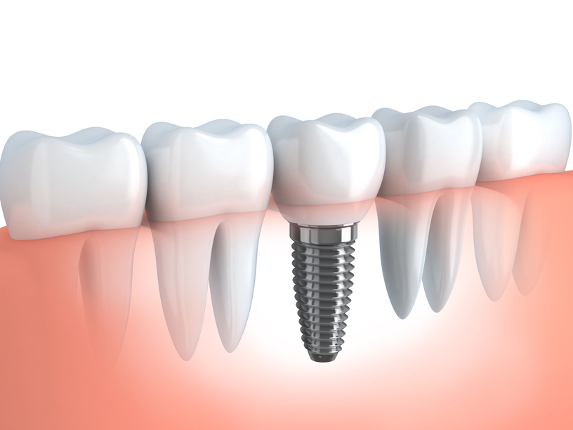 Dalton dental implants