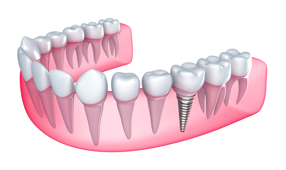 Calhoun dental implants