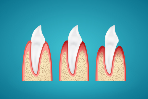 stages of gum disease illustrated
