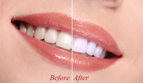 Woman smiling with teeth close-up